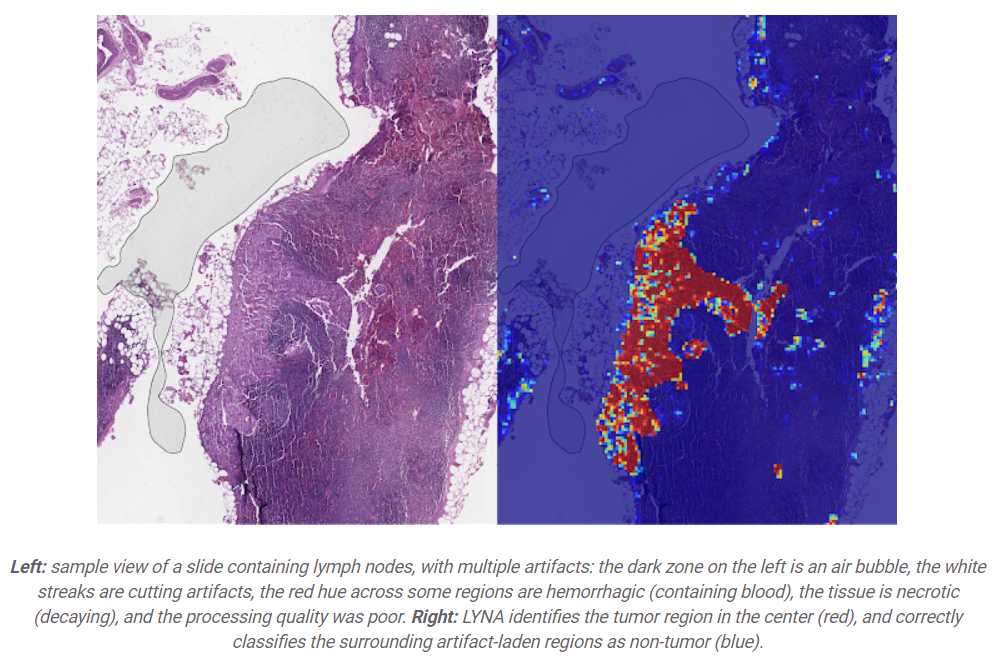 Google's LYNA for Metastatic Breast Cancer Detection, data science case studies